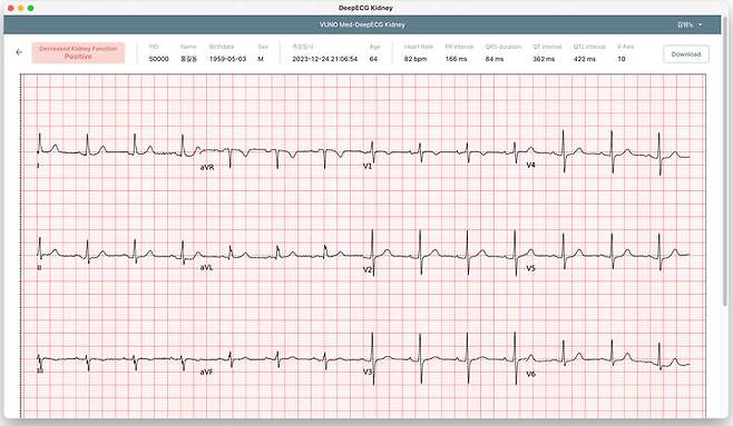 [서울=뉴시스] 의료 인공지능(AI) 기업 뷰노는 AI 기반 콩팥기능 저하 선별 심전도 분석 소프트웨어 뷰노 메드-딥 ECG Kidney의 식약처 의료기기 허가를 획득했다고 9일 밝혔다. (사진=뷰노 제공) 2025.06.09 photo@newsis.com *재판매 및 DB 금지