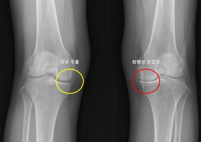 정상 무릎(노란색)과 퇴행성 관절염 무릎(빨간색)의 X-ray 영상. 사진 제공=서울대병원