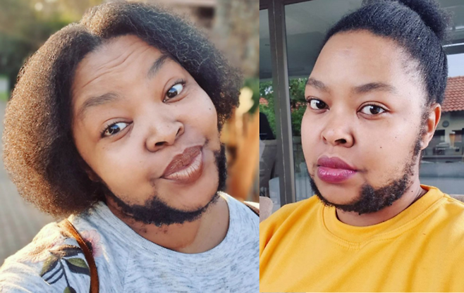 남성 호르몬 과다로 얼굴과 전신에 털이 과도하게 자라는 다모증을 앓는 한 여성이 더이상 면도를 하지 않고 수염 기른 상태로 지내는 생활에 대해 공유했다. [사진=SNS]