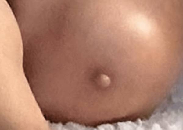 무릎에 생긴 단단한 무색소성 덩어리가 피부암의 일종인 것으로 밝혀졌다./사진=큐레우스 저널