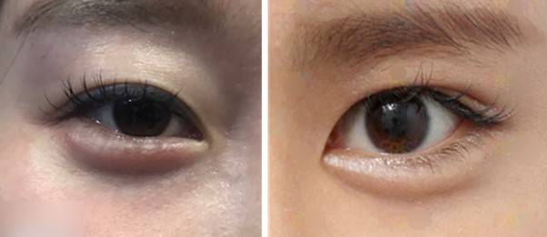 애교 필러 시술이 잘 되었다는 광고 사진 중에서도 자연스러운 애교살의 모습을 보이는 사진은 전무하다고 느낄 정도입니다. 시간이 지나면서 모양이 자연스럽게 유지되기는 더 힘들다는 점도 문제입니다. (구글에서 쉽게 검색되는 사진들입니다)