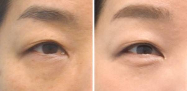 <눈밑지방 재배치 후 돌출된 지방주머니에 가려졌던 애교살이 다시 드러날 수 있습니다.