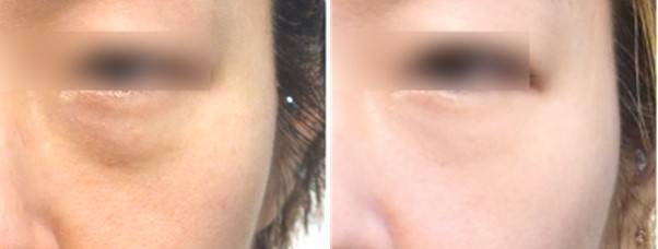 눈밑지방재배치는 원래 있던 애교살이 드러나게 하는 것이므로, 원래 애교살이 발달한 눈이 아니라면 애교살이 두드러지는 효과는 크지 않습니다.