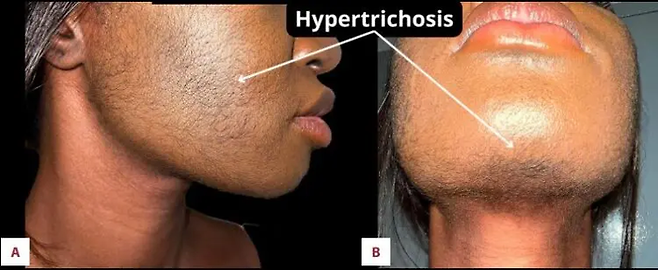 탈모 치료제로 널리 사용되는 미녹시딜(Minoxidil)의 부적절한 사용으로 다모증이 발생한 여성의 사례가 보고됐다. [사진 출처 = 미국 사례 보고서 저널]