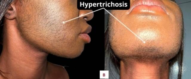 탈모 치료제 미녹시딜(Minoxidil)의 부적절한 사용으로 다모증이오잉 발생한 여성의 사례가 보고됐다. American Journal of Case Reports