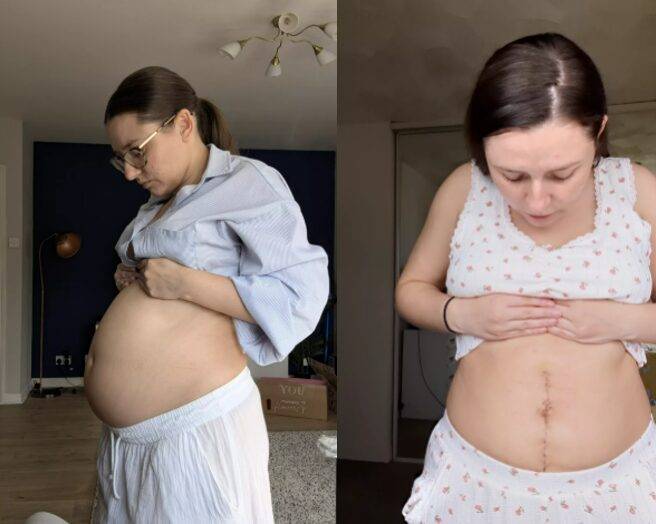 한껏 나온 배 때문에 임신 오해를 받던 여성이 거대한 난소 낭종을 제거한 사연이 소개됐다. [사진=SNS]