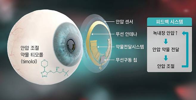 녹내장 환자의 안압 모니터링 및 안압 조절 약물 전달 피드백 시스템 모식도. /포스텍