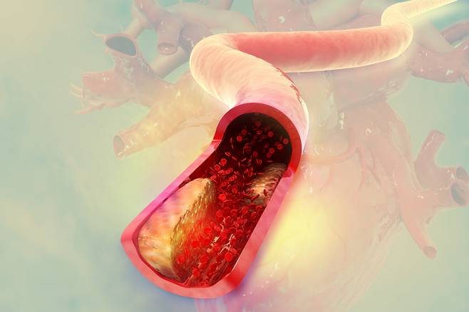 감자에서 추출한 폴리페놀이 콜레스테롤을 투여한 흰쥐의 간장에서 지질 과산화를 억제하는 것을 확인했다. [사진= 게티이미지뱅크]