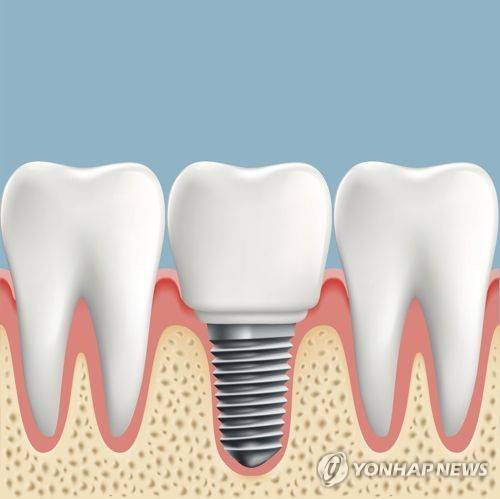임플란트 [게티이미지뱅크 제공]