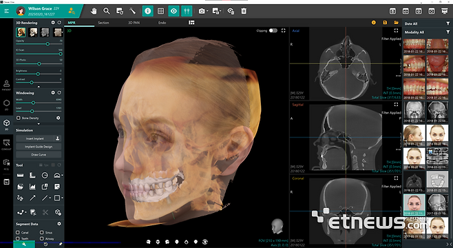 바텍 '바텍 클레버 원' 구동 화면