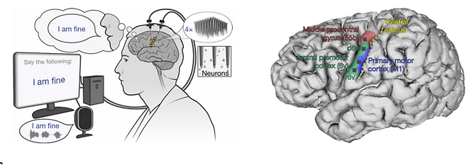 환자가 말하고 싶은 생각을 떠올리면, AI가 이를 읽어낸 뒤 음성으로 전환해 준다. [사진=네이처]