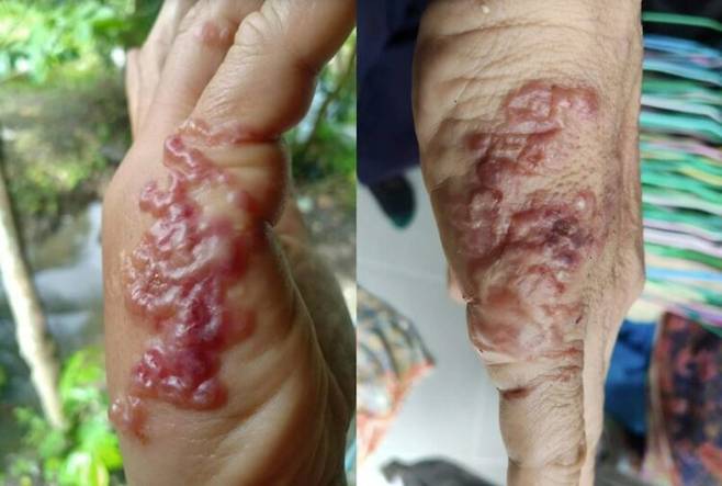 한 태국 여성이 야외에서 잡초를 뽑은 후 구불구불한 발진이 생기고 극심한 가려움증을 겪었다. 여성은 피부 유충 이행증 진단을 받았다. [사진=SNS]