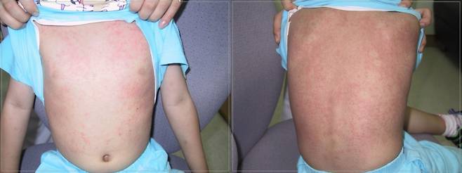 성홍열 환자의 몸통 발진 양상./사진=창원파티마병원