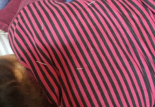 의료법 위반 혐의를 받는 70대 A씨가 환자의 옷 위로 침을 놓은 모습. 사진 제공=제주자치경찰단