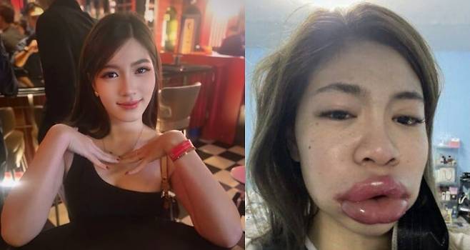 태국 여성 키티야 메나루지의 시술 전후 모습. /페이스북