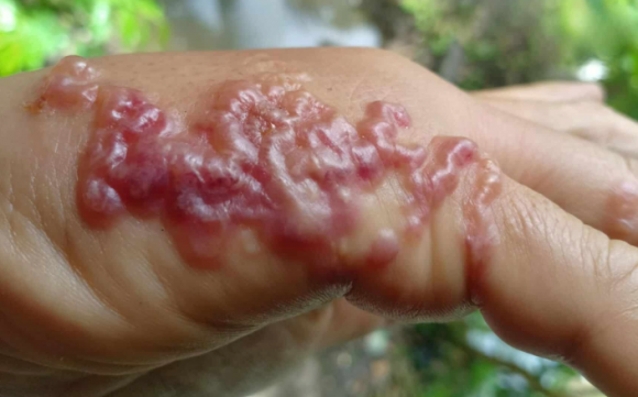태국의 한 남성이 손등에 고름처럼 보이는 수포가 가득한 사진을 소셜미디어(SNS)를 통해 공개해 눈길을 끌고 있다. 해당 사진을 본 누리꾼들은 감염병, 알레르기 등 다양한 추측을 내놨지만, 수포는 ‘피부 유충 이행증’(Cutaneous Larva Migrans·CLM)이라는 기생충 감염 질환으로 인해 나타난 것으로 알려졌다. 페이스북 캡처