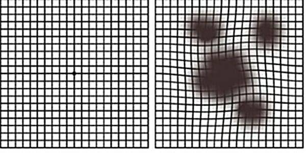 (왼쪽부터) 정상인과 황반변성 환자의 시야. (사진=분당제생병원)