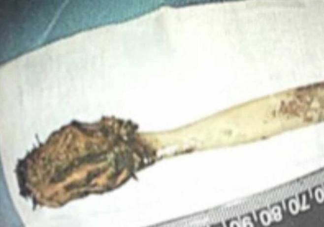 중국의 64세 남성이 12살 때 삼킨 칫솔을 52년 만에 내시경 수술로 제거했다. 칫솔은 장에 고정돼 있었지만 큰 이상 없이 제거됐으며, 의료진은 이같은 사례는 매우 이례적이라고 밝혔다. ⓒ뉴시스