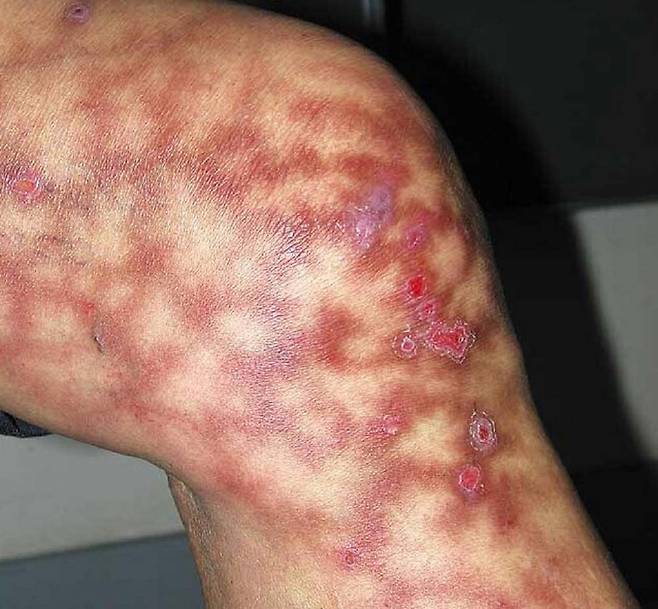 영국의 한 피부과 전문의가 열성 홍반의 위험성에 대해 경고했다./사진=The New England Journal of Medicine