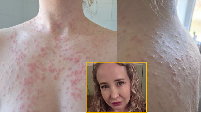 40번째 생일을 맞아 친구들과 함께 여행을 떠난 한 여성이 호텔 온수 욕조 이용 후 전신에 퍼진 발진으로 극심한 고통을 겪은 사연이 전해졌다. [사진=SNS]