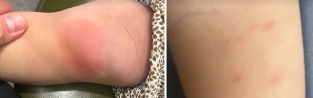 대구의 한 호텔 객실에서 진드기에 물려 피부가 붉게 변한 아이들. TBC