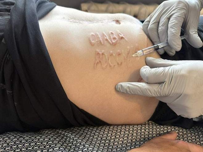 러시아에 포로로 잡혔던 우크라 군인의 배에 새겨진 ‘러시아에 영광을’ 연합뉴스