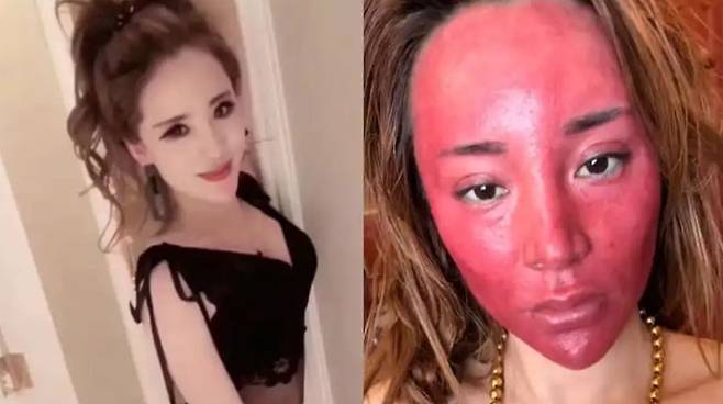 22년간 화장을 제대로 지우지 않은 30대 여성의 얼굴이 최근 붉게 변했다. 발진, 가려움, 열감 등도 동반됐다. [사진=SNS]