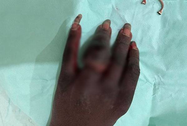 손가락에 반지가 껴 심하게 부은 A씨의 손가락 사진./사진=니드투노우