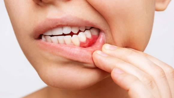 입속 염증과 잇몸 질환에 '숭늉'이 효과적이라는 전문가의 설명이 소개됐다. 사진은 본 기사 내용과 무관. [사진= Valley Dental Care]