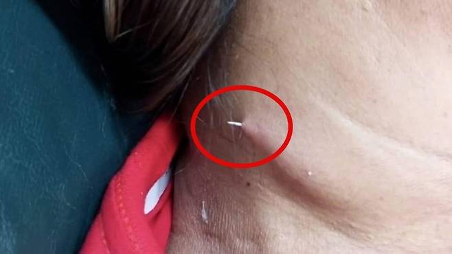 목에 걸린 생선 가시가 피부 밖으로 뚫고 나온 태국 사례. 사진=페이스북 캡처