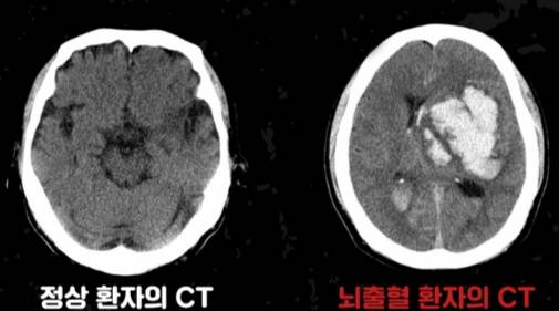 정상 환자의 뇌CT(컴퓨터단층촬영) 사진(왼쪽)과 뇌출혈 환자의 뇌CT 사진(오른쪽) 비교. 뇌출혈 환자의 사진을 보면 뇌혈관이 터진 부위가 하얗게 찍혀 있다./사진=분당서울대병원