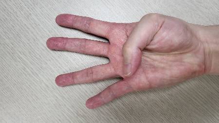 손바닥을 편 채 엄지손가락을 접었을 때 바깥 경계를 넘어서면 대동맥류가 있을 가능성이 있다./사진=강동성심병원