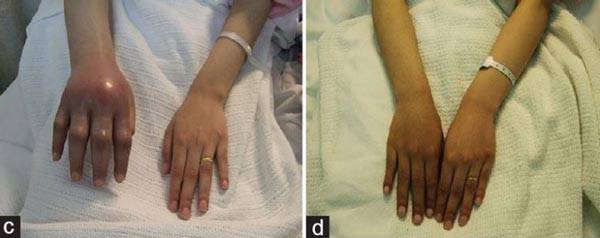복합부위통증증후군 때문에 증상 부위가 붓고 피부색이 변한 모습./사진=Annals of African Medicine