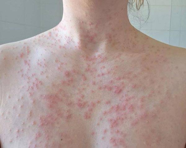 프란체스카 뉴튼(40)은 지난 3월 호텔 욕조에 몸을 담갔다가 전신에 모낭염이 생겼다./사진=더 미러