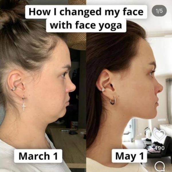 '2개월간 얼굴 요가를 한 여성의 안면 윤곽 변화'라며 올라온 사진./사진=인스타그램 캡처