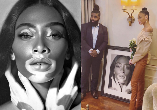 영국 화가 켈빈 오커퍼(Kelvin Okafor)가 연필만으로 피부 질환과 외상을 지닌 인물들의 초상화를 그려내며 주목받고 있다. 그는 피부에 남은 자국을 단순한 외형이 아닌 삶의 일부로 바라보며, 이를 정밀한 드로잉으로 기록했다. (사진=@kelvinokafor_art)