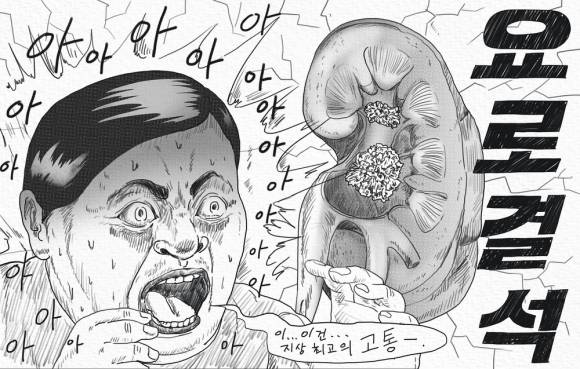 요로결석 자료 이미지. 아이클릭아트