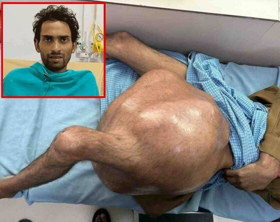 6년간 다리에 생명을 위협하는 종양을 달고 살던 남성이 다시 걷기 위해 최근 종양을 제거한 사연이 소개됐다. 이 남성은 연골육종을 앓고 있다. [사진=SNS]