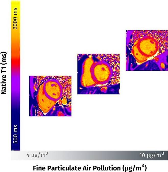 "초미세먼지(PM2.5), 심근 섬유화 유발" 초미세먼지(PM2.5) 농도가 심근 섬유화(myocardial fibrosis)에 미치는 영향. PM2.5 농도가 높아지고(4㎍/㎥→10㎍/㎥) 노출 기간이 길어질수록 심근 섬유화 증상(노란색~주황색 부분)도 심해지는 것으로 나타났다. [Radiological Society of North America(RSNA) 제공. 재판매 및 DB 금지]