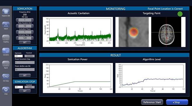 집속초음파로 뇌 속 BBB를 실시간 제어하는 모습 / 출처=뉴머스