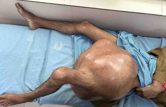 인도 우타르프라데시에 거주하는 모하메드 살만(27)은 지난달 9일 왼쪽 허벅지에서 약 35kg의 암 종양을 제거했다. 데일리메일 캡처