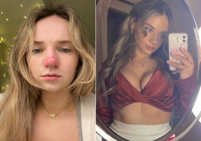 제시카 맥기르(24)는 5년 전 스페인에서 휴가를 보낸 뒤 코가 붉어졌다. 5년간 이어진 붉은기 탓에 제시카는 매일 외출할 때마다 화장으로 피부를 가리면서 지내는 중이다. [사진=SNS]