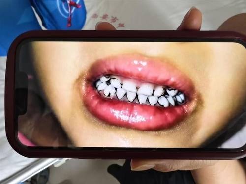 중국서 납중독 의심으로 치아 일부가 검게 변한 유치원생. [중국 매체 지무뉴스 캡처]