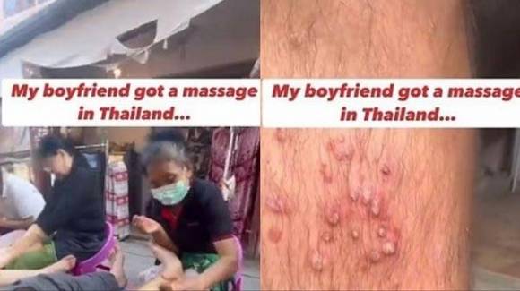최근 미국 응급의학과 전문의가 태국 골목길에서 마사지를 받은 뒤 다리에 심각한 염증이 생긴 남성 사례를 소개하며 저렴한 발 마사지에 대해 경고했다. /사진=SNS 갈무리