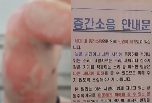 지난 5일 대전 서구의 한 빌라에서 60대 A씨가 층간소음을 알아보러 온 이웃에게 뜨거운 식용유를 끼얹고 흉기로 위협한 사건이 발생했다. 경찰이 A씨를 특수상해 및 특수협박 혐의로 구속영장을 신청한 가운데, 피해자는 전신 3도 화상을 입었다. 자료 : TJB뉴스