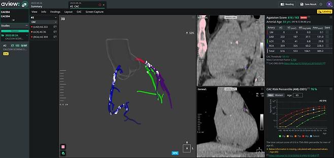AVIEW CAC [코어라인소프트 제공]