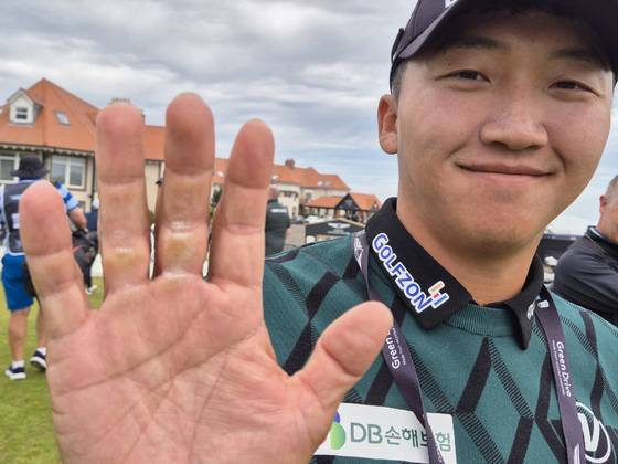 김홍택이 제네시스 스코티시 오픈이 열리는 더 르네상스 클럽에서 굳은 살이 박힌 손을 보이고 있다. 성호준 기자