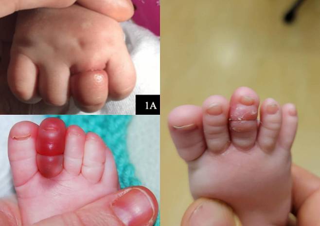 미국 아칸소에서 15개월 아기가 누나의 긴 머리카락에 목이 졸려 기절하는 사고가 발생했다. 빠른 응급조치로 무사히 회복했지만, 의료진은 긴 머리카락처럼 일상 속 물건도 영유아에겐 치명적일 수 있다며 주의를 당부했다. (사진=SNS)