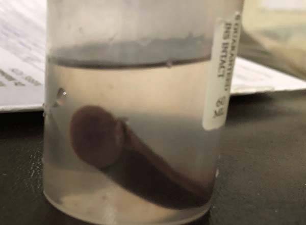 농촌에 거주하는 30대 남성이 깨끗하지 않은 연못의 물을 마셨다가 거머리가 목으로 침투한 사건이 보고됐다. 사진은 남성의 목에서 나온 7~8cm 크기의 거머리./사진=큐레우스