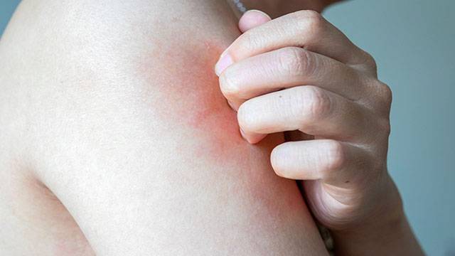 만성 피부 질환이 있다면 여름철 피부 관리에 신경써야 한다|출처: 게티이미지뱅크